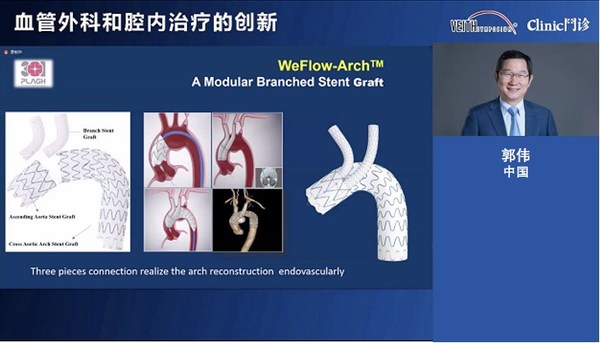 郭伟教授作为WeFlow-Arch™的主要研究者介绍产品创新及临床表现