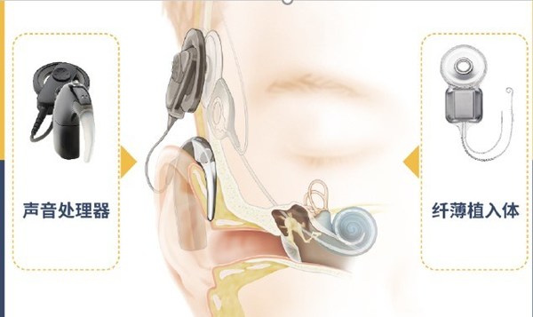 人工耳蜗系统包括植入体和声音处理器两部分。对80分贝以上重度到极重度听力损失患者而言，人工耳蜗是一项成熟有效的解决方案。